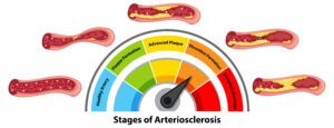 Cholesterol